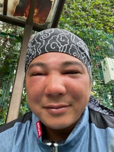 ハチに顔面を刺されイケメンフェイスが大変な事になりました
